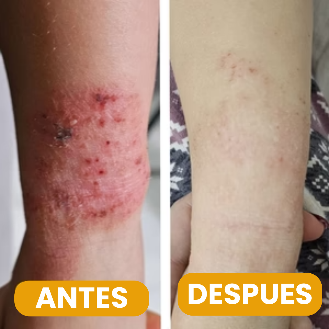 Crema dermatitis para Niños